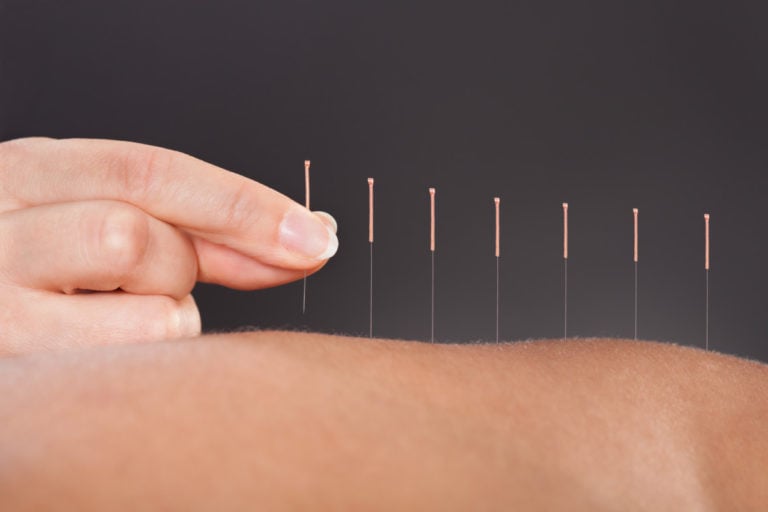 Acupuncture is a key component of Traditional Chinese Medicine